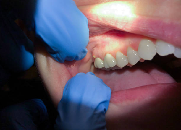 Best Emergency Tooth Extraction in Lake Summerset, IL